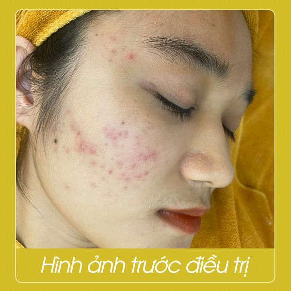 La Beauty - Spa Trị Mụn Tại Đà Nẵng