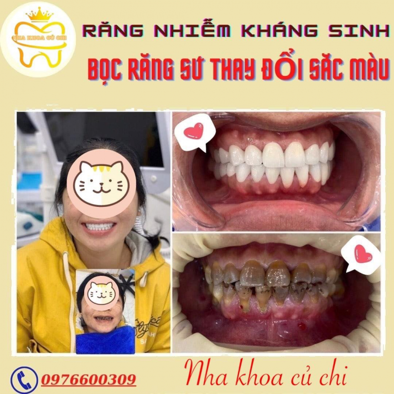 NHA KHOA CỦ CHI luôn hoàn thành sứ mệnh đem đến một nụ cười chắc khỏe cho mỗi khách hàng