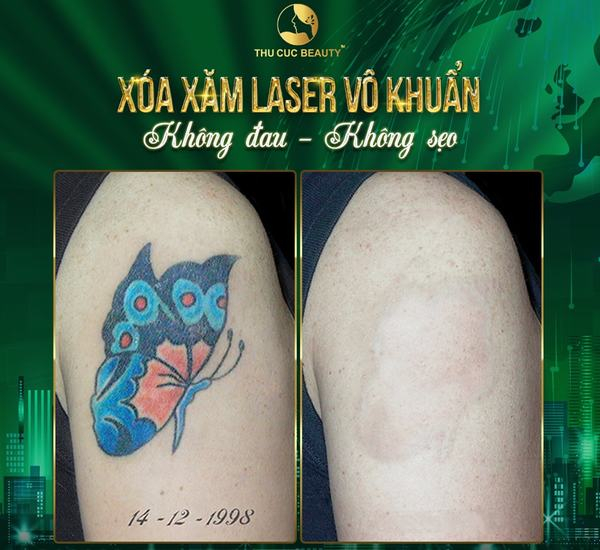 An toàn - Không đau - Không sẹo tại Thu Cúc