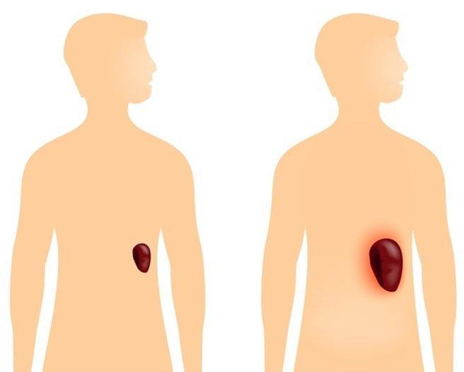 Tìm hiểu về 6 cách chữa bệnh tăng bạch cầu đơn nhân nhiễm khuẩn